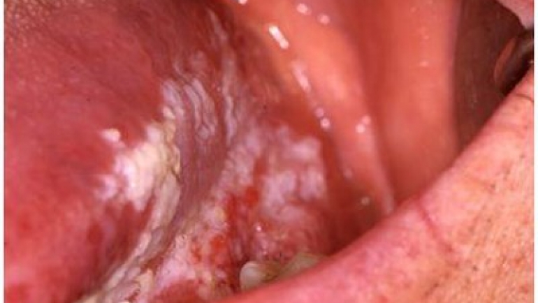 Cancro oral